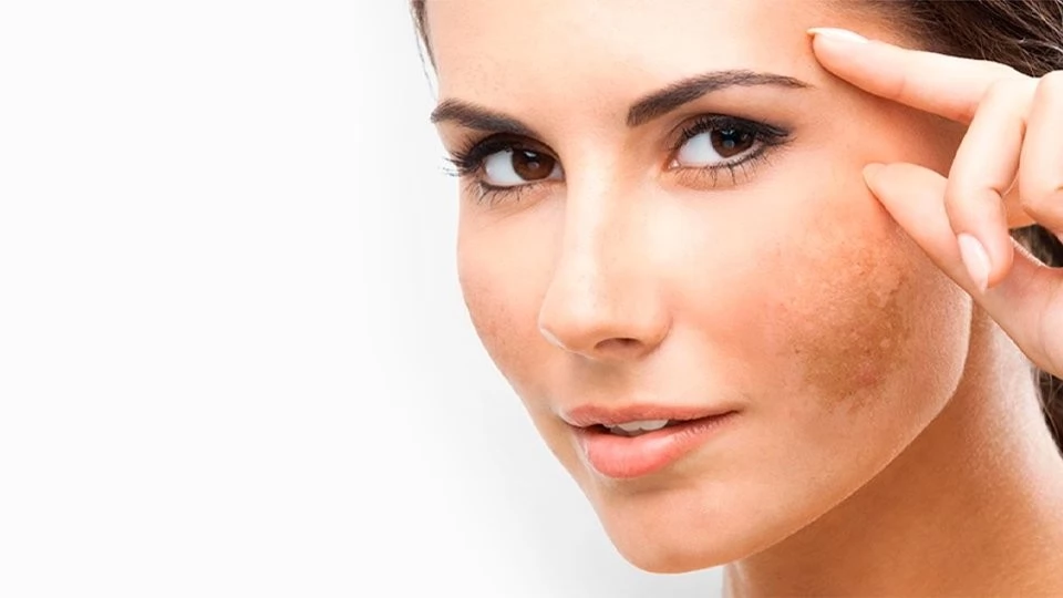 O que é<strong> Melasma?</strong>